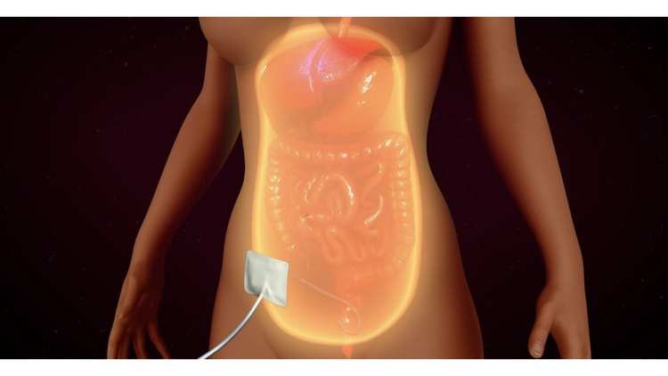 Peritoneal Dialysis Menu Tile
